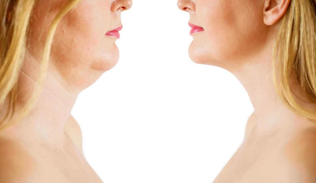 Double Chin treatment Norfolk before and after results