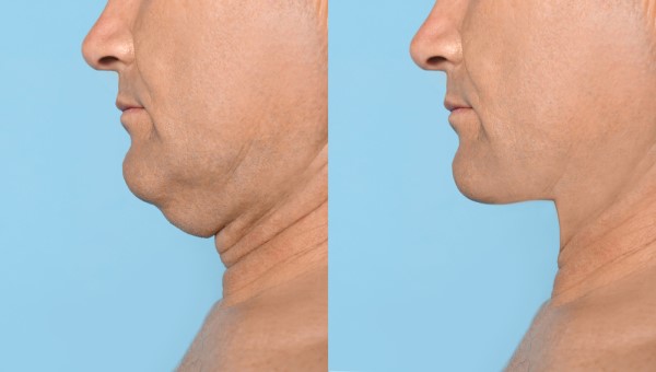 Which Non-Surgical Treatments Work Best for Jowls and Loose Skin Norfolk?