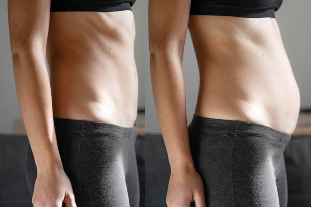 How long does diastasis recti take to improve Norfolk?