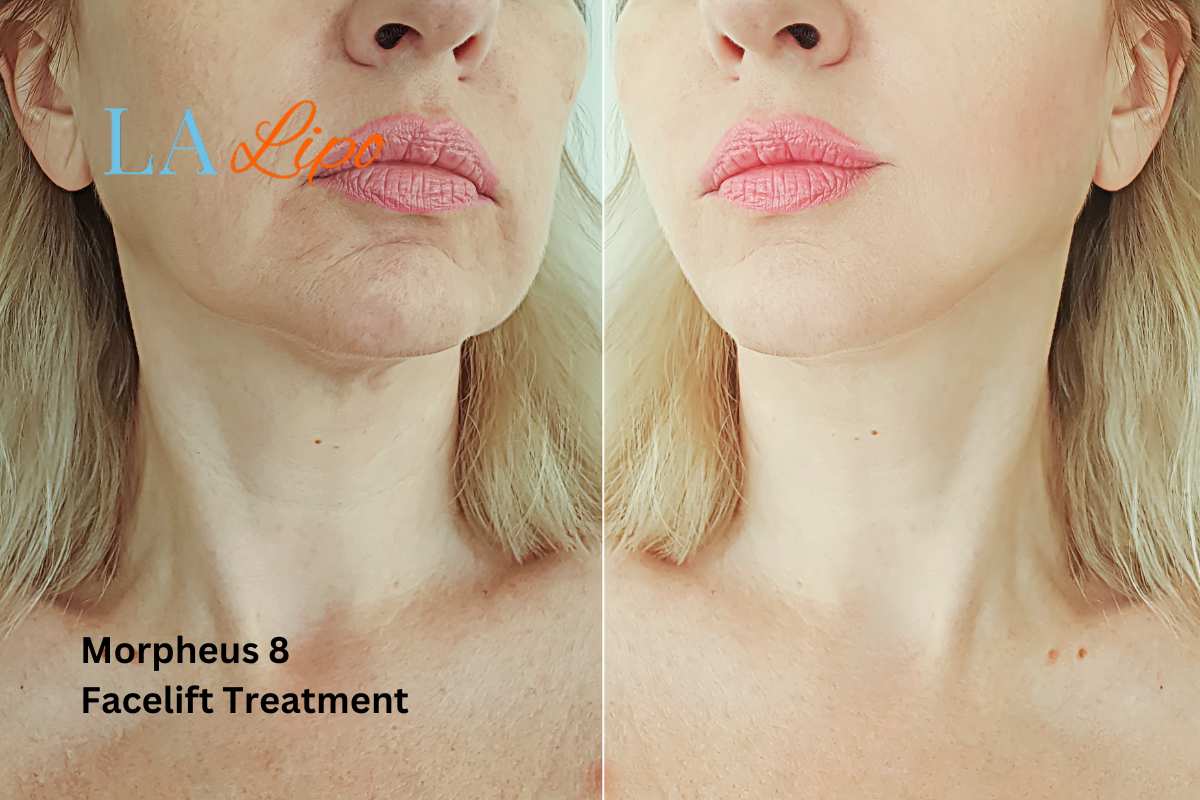 Turn back time with Morpheus8 Treatment Norfolk