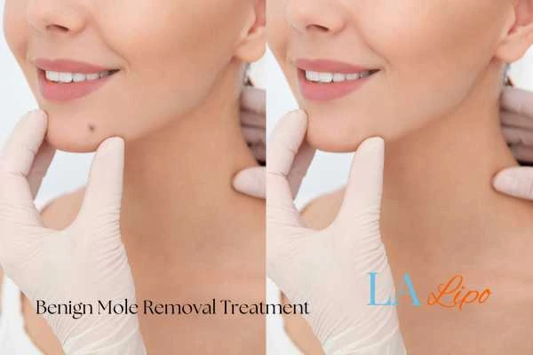 woman's before and after mole removal Norfolk results