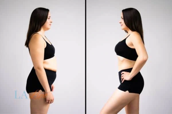 image of woman before and after results of LA-EMS Body Sculpting Norfolk to help treat Diastasis recti