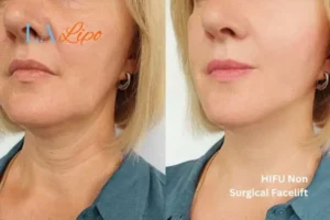 hi-fu for wrinkles Norfolk before and after results
