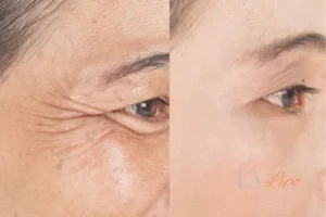 Before and after results of woman - HI-fu wrinkles reduction treatment Norfolk