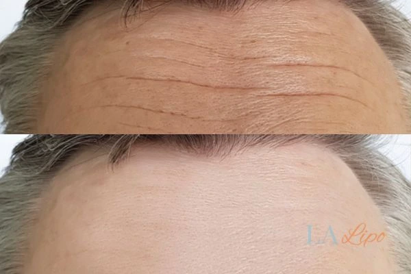 results of HIFU Norfolk on mans forehead to help reduce lines and wrinkles