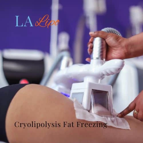 fat freezing - Cryolipolysis Norfolk
