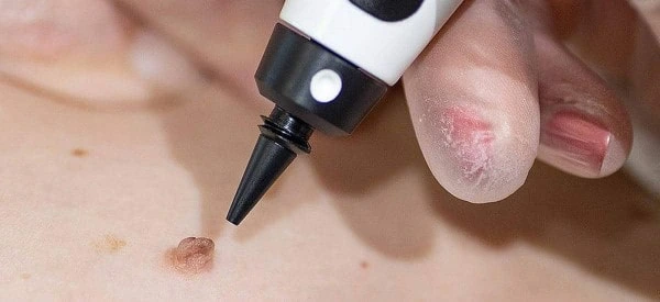 skin tag removal using cryopen Norfolk