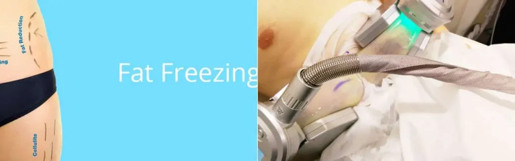 Fat freezing Norfolk on multiple areas of the body