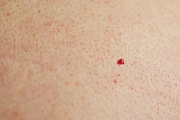 close up of a cherry angioma Norfolk