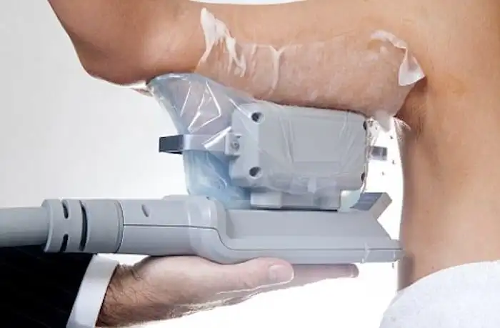 Picture of fat freezing Norfolk on the upper arms.