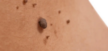 image of a skin tag Norfolk