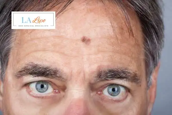 Solar Lentigo Removal Norfolk image of man with mark on his forehead
