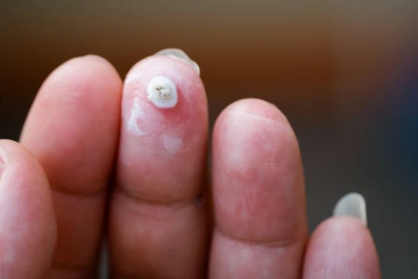wart on person finger - cryotherapy to treat from LA LIPO Norfolk