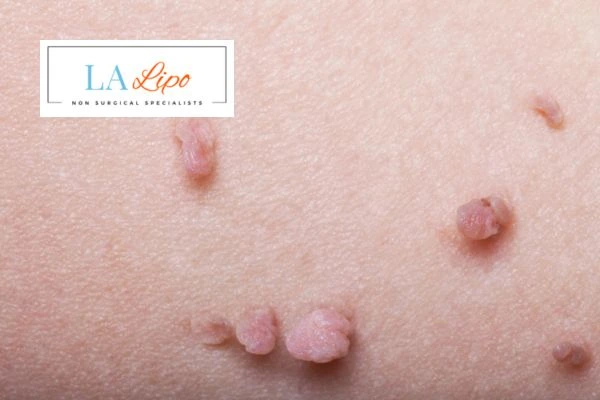 Does cryopen skin tag removal Norfolk hurt? Find out now call our team today!