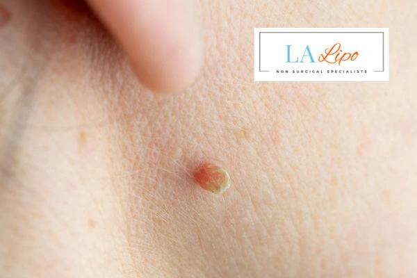 Book skin tag removal Norfolk today speak to our team now!