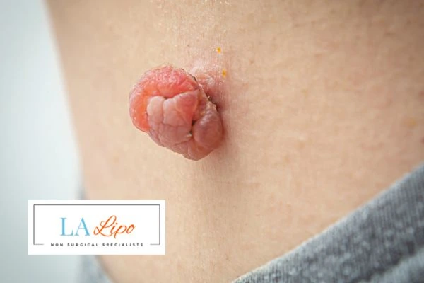 Interested in skin tag removal Norfolk? Concerned about the pain? Find out more today!