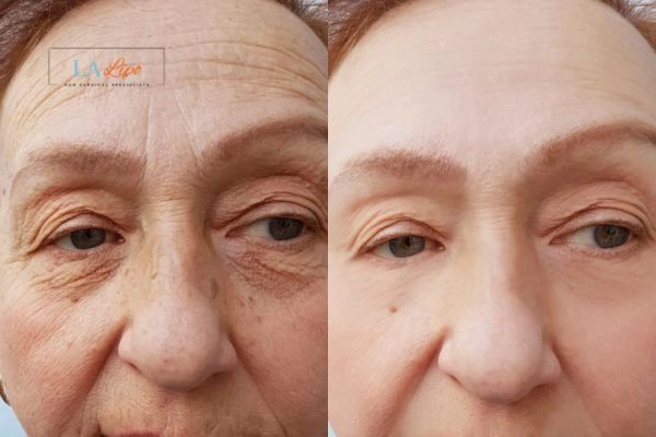 The powerful benefits of Morpheus8 Treatment Norfolk - Call Our team today!