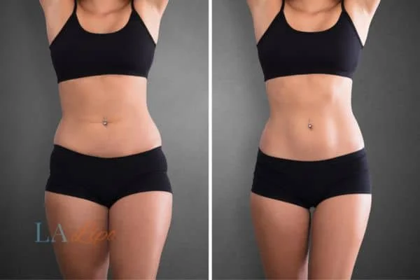 before and after results of non-surgical treatment to help a woman's body image and mental health Norfolk