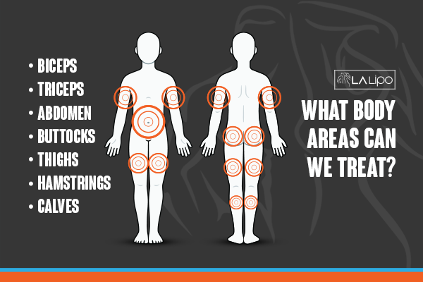 Diagram to show areas you can have LA-EMS Body Sculpting Treatment Norfolk