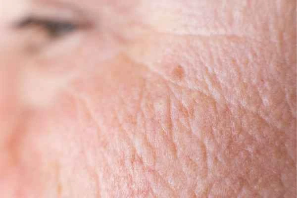 close up picture of a woman's face showing an age spot Norfolk