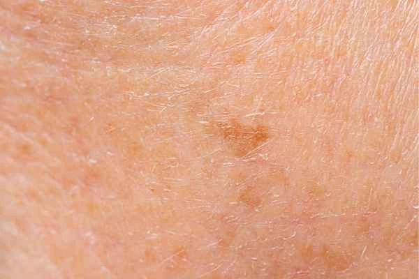 close up picture of age spots Norfolk