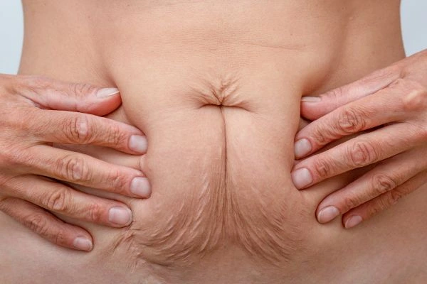 Image of a woman's stomach with loose skin - example of skin tightening Norfolk options