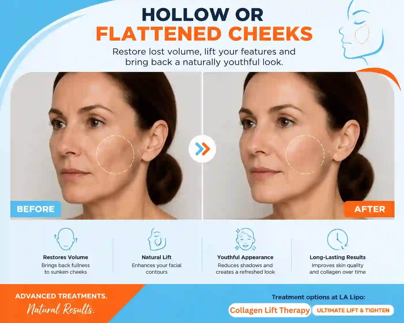 Sign #4: Hollow or Flattened Cheeks Norfolk
