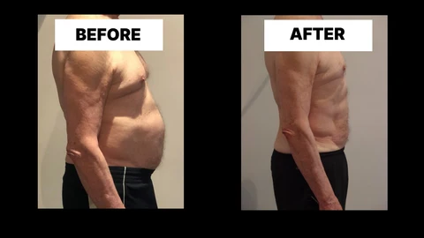 What Symptoms Can Diastasis Recti Cause in Men? Weak Core, Back Pain and Poor Posture Norfolk